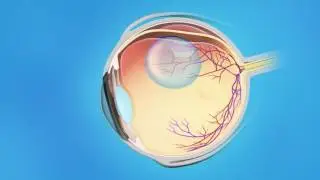 Retina Detached Pneumatic Retinopexy