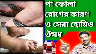 পা ফোলার হোমিও  ঔষধ  ।।  পা ফুলা হোমিও ঔষধ  ।।  leg dropsy