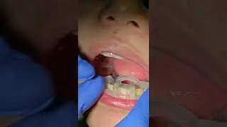 Dental implant placement with Mguide... for accuracy & patient comfort.