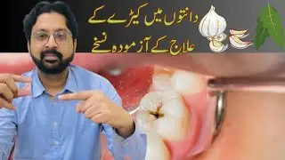Top Home Remedies For Tooth Cavity | Dental Caries @ateeqdentalcare