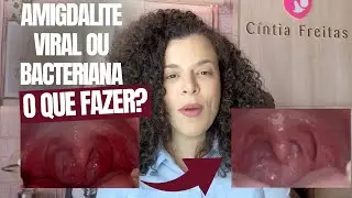 Diferen&ccedil;a entre Amigdalite Viral e Bacteriana, como tratar.