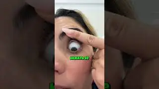 I lost a lens in my eye😱