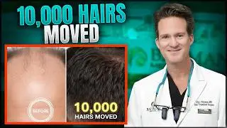 Dave Asprey’s 10,000-follicle FUE Hair Restoration | Reversing Testosterone Hair Loss w/ Dr. Bauman