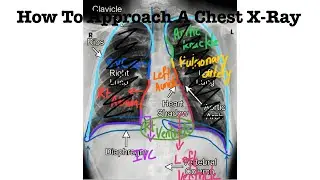 How To Read A Chest X-Ray for Undergraduates in 3 minutes 🔥🔥🔥#viral 