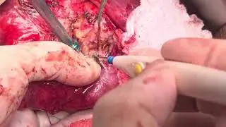 Berne Modification of Beger Procedure for Chronic Pancreatitis