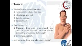 Brain Tumours (44):  Pituitary Adenomas (3):  Endocrinopathies  أورام الغدة النخامية