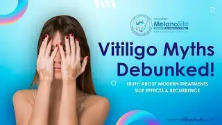 Vitiligo Treatment Myths: Truth About Side Effects of Modern Medicine