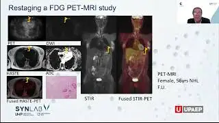 PET y tomografías computarizadas en el diagnóstico de linfoma | Dr. Emanuele Nicolai