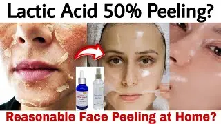 Lactic Acid 50% & Kojic Acid 10% Chemical Peeling| Pigmentation, DarkSpots, Wrinkles & Skin Whitenig