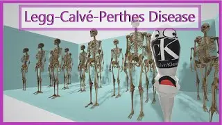 Leg-Calve-Perthes Disease (Mnemonic for the USMLE)