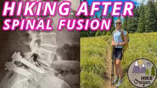 I Had Spinal Fusion Surgery, Now I’m Hiking 14 Miles Again | 1 Year Post Op From PLIF
