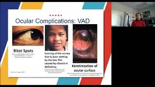 Lecture: An Eye on Vitamin A