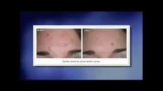 Dr. Lupo discusses the benefits of Isolaz