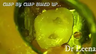 Procedure to seal pulp chamber after root canal treatment .
