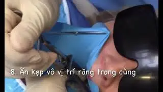 DETAILED INSTRUCTIONS ON HOW TO USE RUBBER DAM