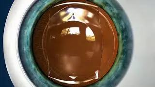 Visian ICL Procedure Video
