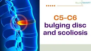 C5 C6 bulging disc and scoliosis #C5C6 #bulgingdisc #scolismart #scoliosis   TreatingScoliosis
