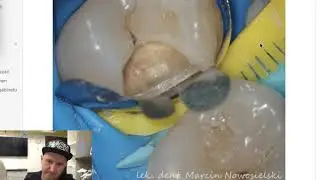 Dental MacGyver - Tips & Tricks e1 (en): Two wedges trick, missing teeth, wide interdental space.