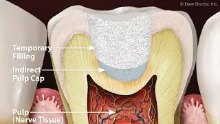 Endodontics - Direct & Indirect Pulp Capping