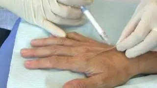 Transform Your Aging Hands with Radiesse | Dr. Fitzgerald