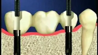 Two Implant Bridge