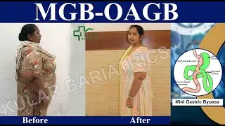 Which Weight Loss Surgery is safe & effective? Detailed discussion from a Patient's point of view .!