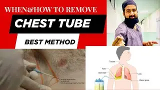When & How to remove chest tube(Chest tube kaise out kren? Don&rsquo;t do these mistakes