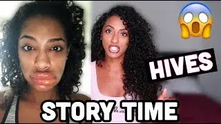 STORY TIME ON CHRONIC HIVES **EMOTIONAL**