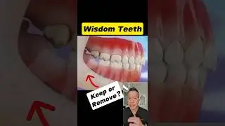 Keep or Extract? The Truth About Wisdom Teeth #dentallan #dentist #shorts