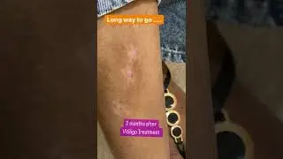 Vitiligo Treatment in Chandigarh| Dermatologistinchandigarh chandigarh #shorts