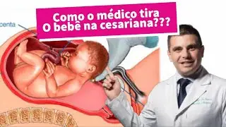 Como o médico tira o bebê na cesariana?