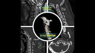 CVJ ANOMALY| ATLANTOAXIAL INSTABILITY| C1C2 fixation| C2 Pedicle screw