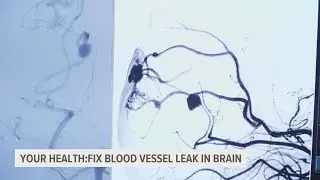 AVM: Gargantuan headaches and leaking blood vessels in the brain