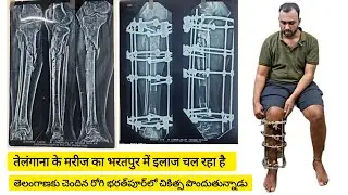 Ilizarov surgery in tibia bone infected & Non-union bone Recovery Update #ilizarovsurgery -Rajesh