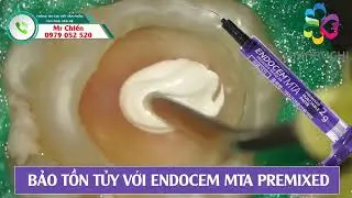 Endocem MTA Premixed