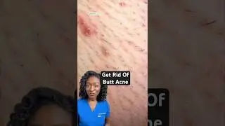 Butt Acne 🍑 Why You Get It & How to Get Rid of It!