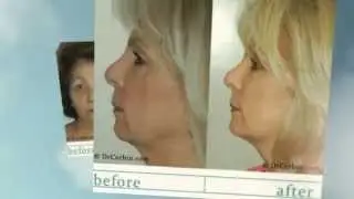 Orange County Facelift Surgeon | Dr. Fred Corbin