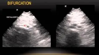US of the Aorta