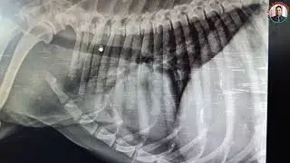 Pulmonary edema: radiographic signs/#Air bronchogram/#loss of cardiac silhouette