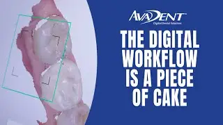 The AvaDent Denture Advantage - The Digital Work Flow is A Piece of Cake