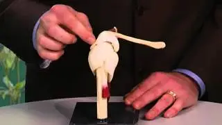 Shoulder Bursitis