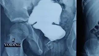 Cystoscopy cauterization of fistulous tract between exstrophy augment and closed off urethra