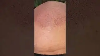 #scalpmicropigmentation #hairlosstreatment #bald
