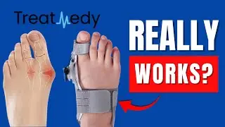 Обзор Treatmedy Bunion Fix &ndash; обман или правда?