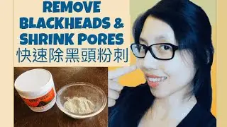 Secrets to Quickly Removing Blackheads (2024)