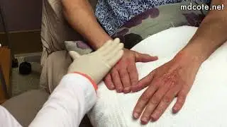 Bellafill Injections for More Youthful Hands