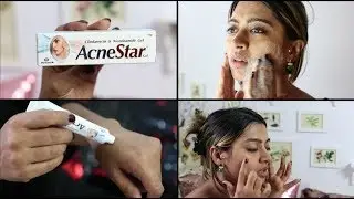 Обзор геля Acnestar &mdash; КАК ДЕЙСТВИТЕЛЬНО ИЗБАВИТЬСЯ ОТ АКНЕ | SuperWowStyle Prachi