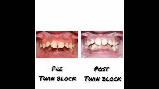 Twin block appliance #functionalappliance #dentistry #dentist #orthodontics #orthodontist
