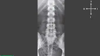 Estudios radiográficos de la columna vertebral interpretación morfológica