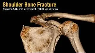 Scapular body fracture involving aromion, coracoid base and Glenoid joint